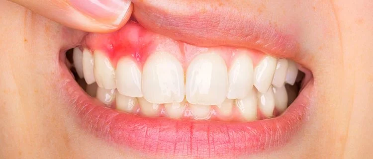 periodontoloji alanını anlatan diş eti görseli