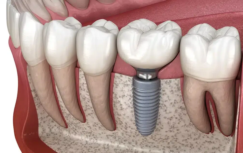 Lokman Hekim Söğütözü Diş Hastanesi dental implant kliniğinde ileri teknolojiyle yapılan ağrısız implant ve vidalı diş tedavisi