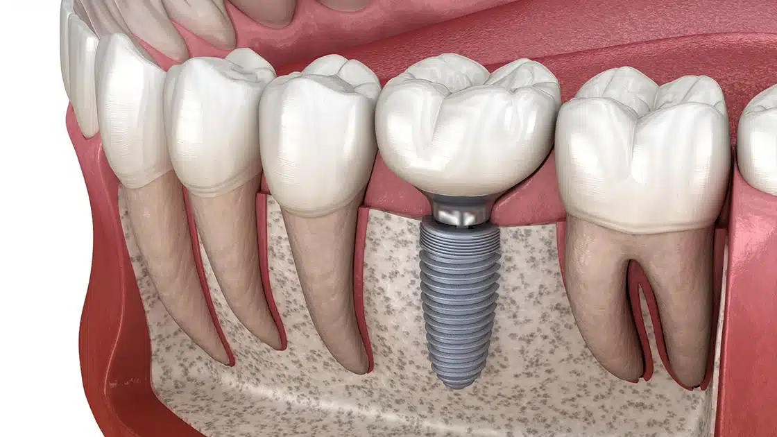 Lokman Hekim Söğütözü Diş Hastanesi dental implant kliniğinde ileri teknolojiyle yapılan ağrısız implant ve vidalı diş tedavisi